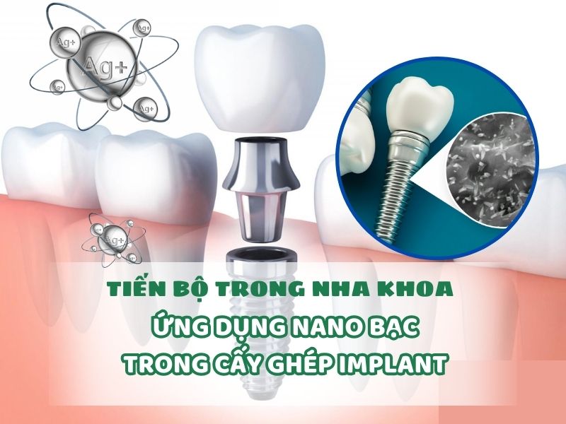 tien-bo-trong-nha-khoa-ung-dung-nano-bac-trong-cay-ghep-implant-1