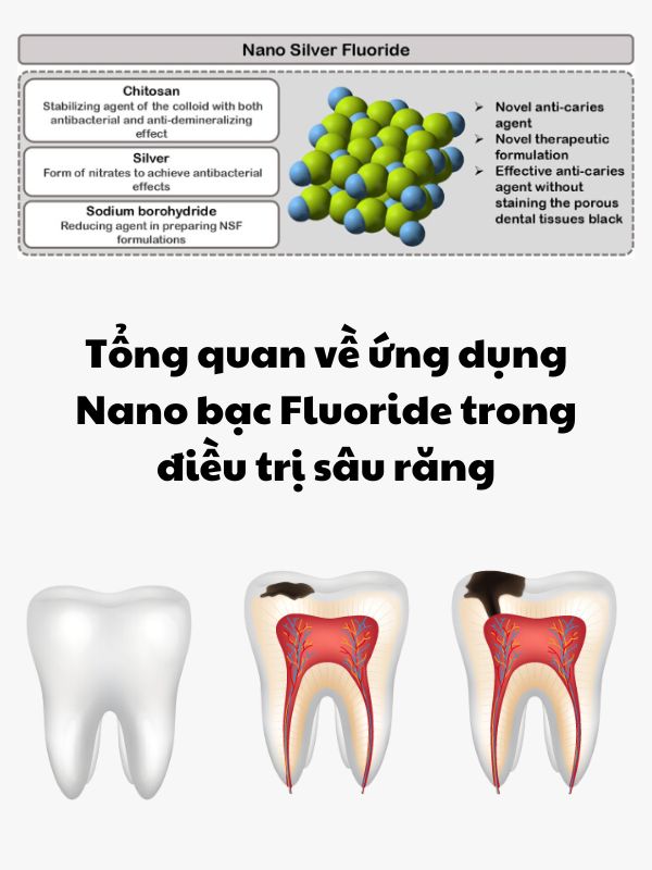 nano-bac-fluoride-chong-sau-rang-giai-phap-moi-trong-cham-soc-rang-mieng-6
